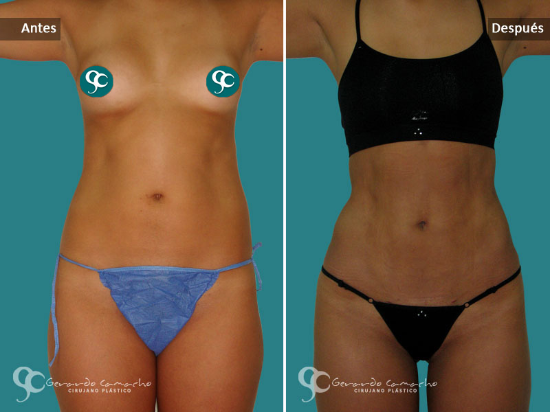 Testimonio Marcacion Abdominal Bogota